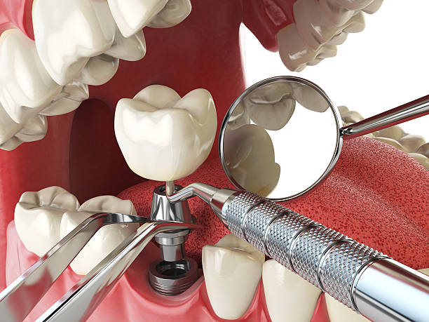 Best Emergency Wisdom Teeth Removal in Ridgetop, TN